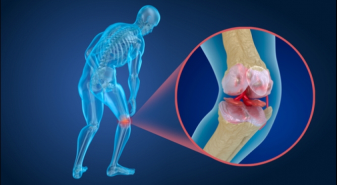 Arthrose